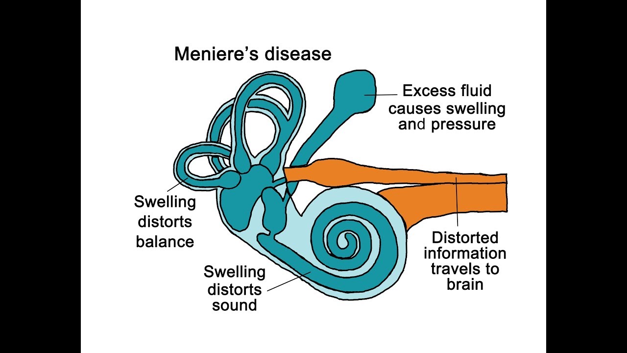Meniere's Disease